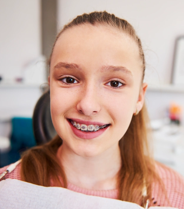 Self-Ligating Braces