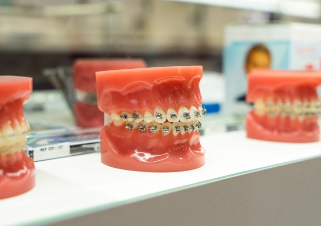 Types of Braces